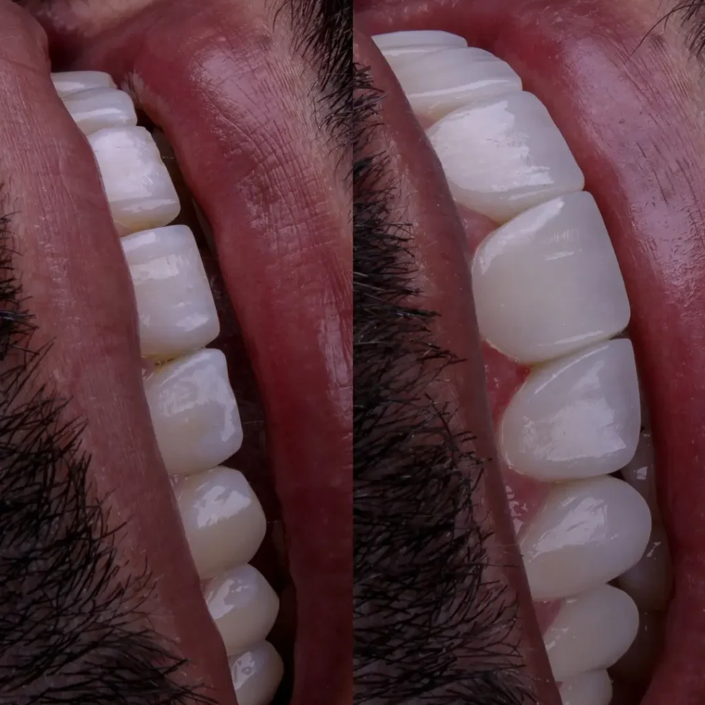 Restauração Dentária