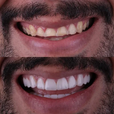 faceta_before_after_3
